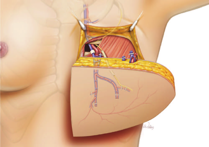 Numbness after Mastectomy: Is There a Solution?