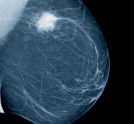 Insurance Companies Must Cover Test for BRCA, the “Breast Cancer Gene”