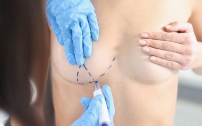 Ask the Plastic Surgeon: Does breast reduction surgery lower the risk for breast cancer?